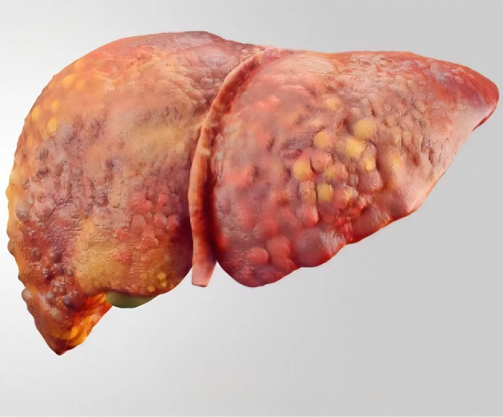 Fatty Liver